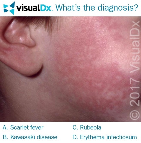 What’s the Diagnosis? - February 27, 2017 | VisualDx