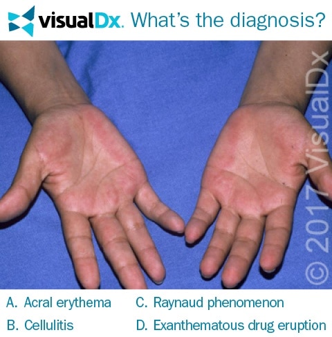 Man Undergoing Chemo Contracts Rash on Hands and Feet - Let’s Diagnose ...