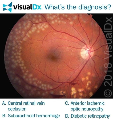 Woman Has Eye Hemorrhage and Vision Problems - Let’s Diagnose | VisualDx