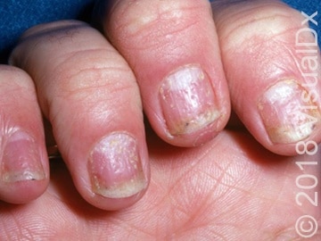 Resident Encounters Patient with Joint Pain, Nail Pitting & Confirms Dx ...