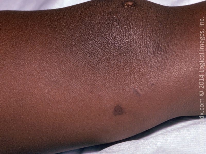 darker than normal pigmentation that appears as dark splotches is called: