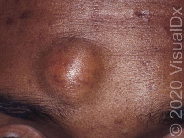 Diagnosing On The Spot A Guide To Solitary Lesions Vi