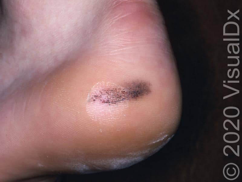 Diagnosing On The Spot A Guide To Solitary Lesions Visualdx