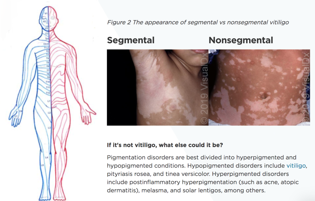 Spotting The Diagnosis Of Vitiligo Visualdx 8807