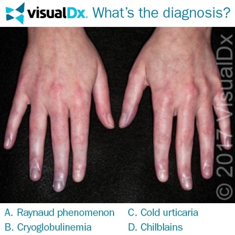 Teen’s Summer Job Affecting Her Hands: Can You Diagnose? | VisualDx