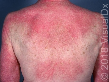 Medical Student Encounters Vague Rash, Uses VisualDx to Diagnose | VisualDx