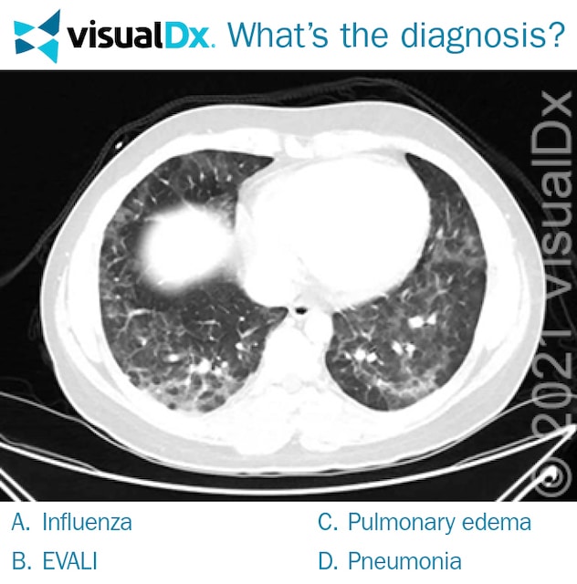 Ct Shows Ground Glass Opacities In Man’s Lungs Let’s Diagnose