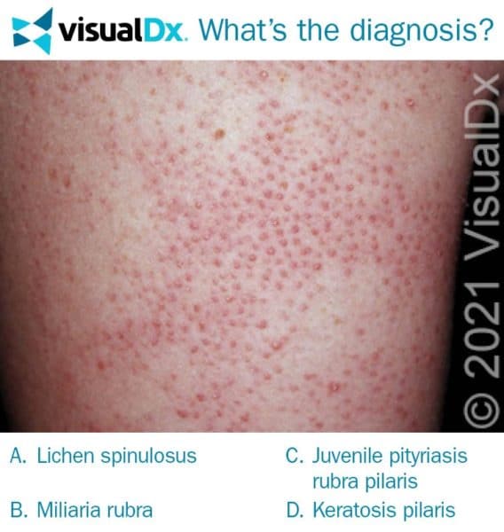 Girl Has Tiny Papules Bilaterally on Upper Arms - Let’s Diagnose