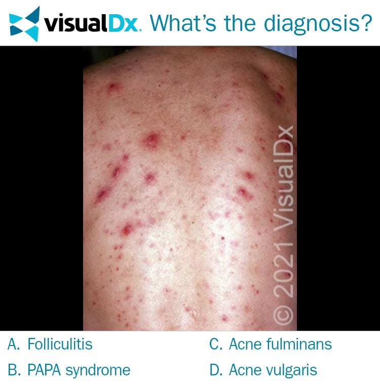 Transgender Man with Fever, Truncal Eruption - Let’s Diagnose