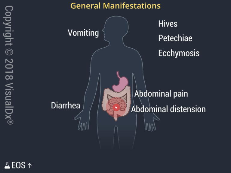 Strongyloidiasis | VisualDx