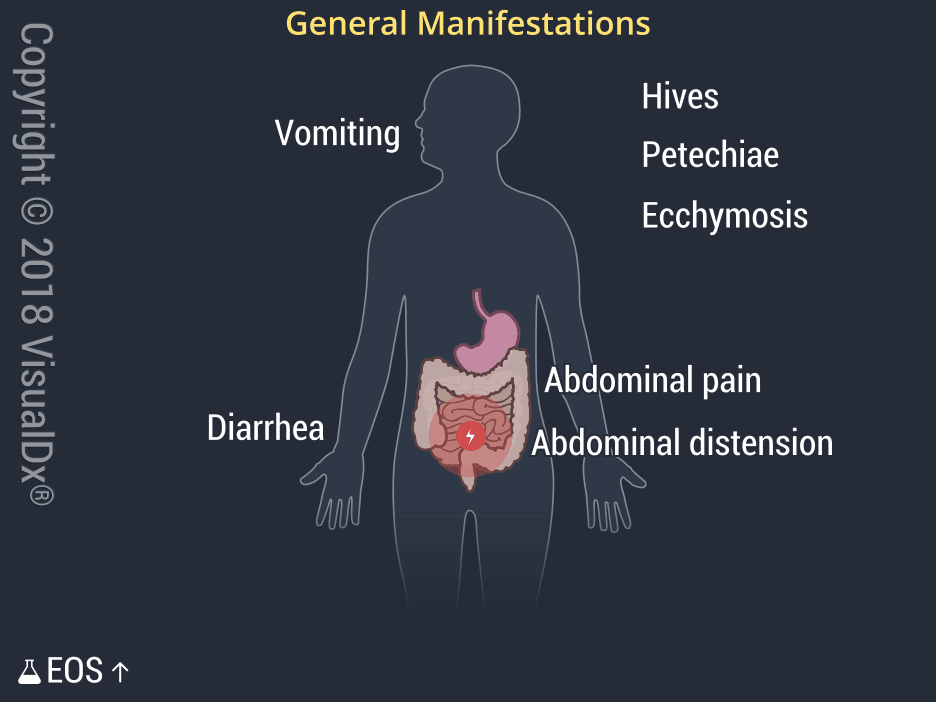 Strongyloidiasis | VisualDx