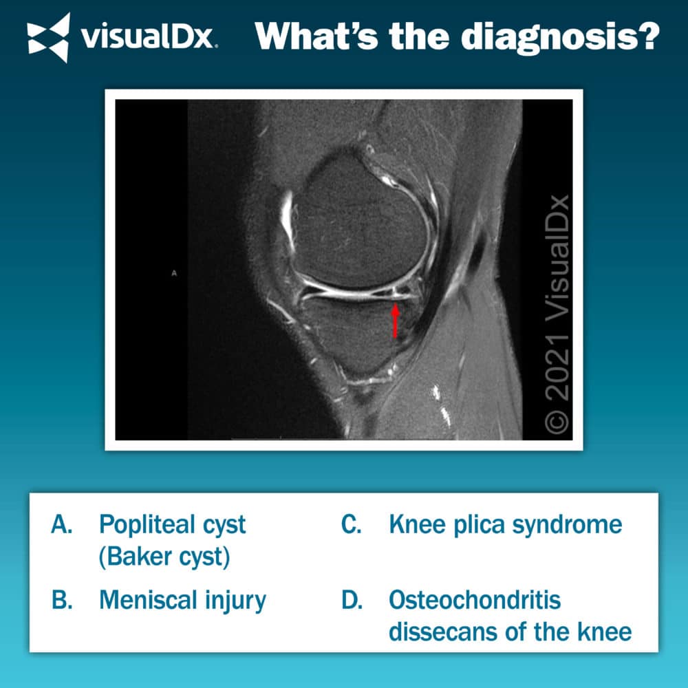 Soccer Player With Knee Pain, Edema - Let’s Diagnose