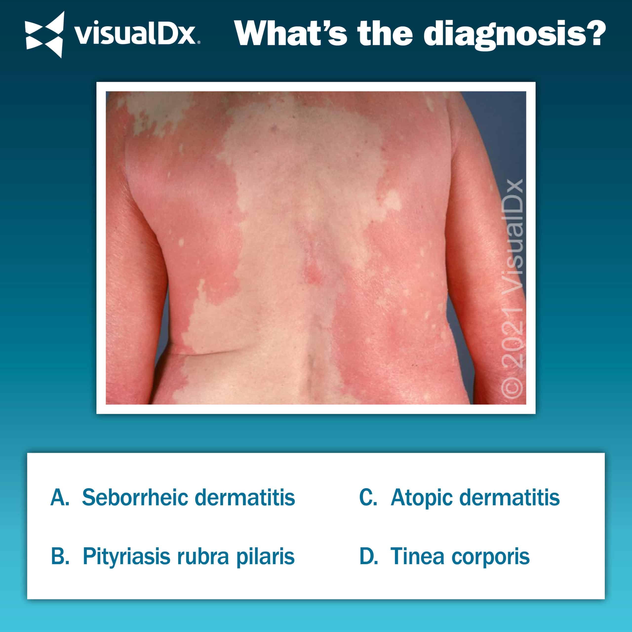 Tinea Cruris: Causes, Symptoms, and Treatment - Skinsight