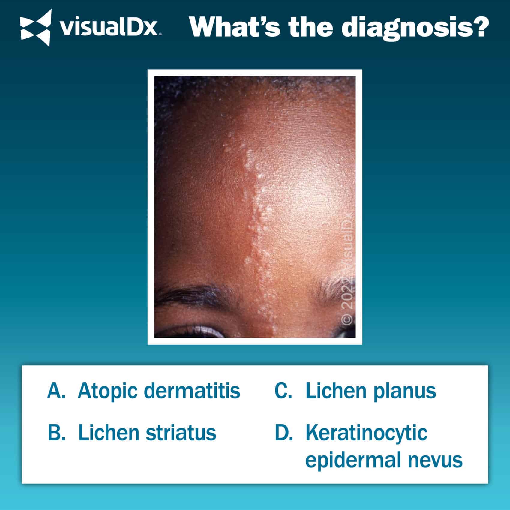 Girl Has Facial Rash With Linear Configuration Lets Diagnose 5599