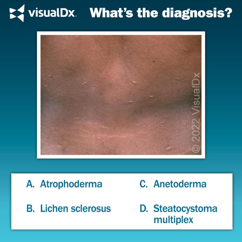 Man has skin atrophy, papules, macules - Let’s Diagnose