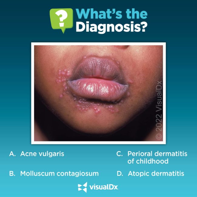 Boy has smooth, pink papules around his mouth - Let’s diagnose