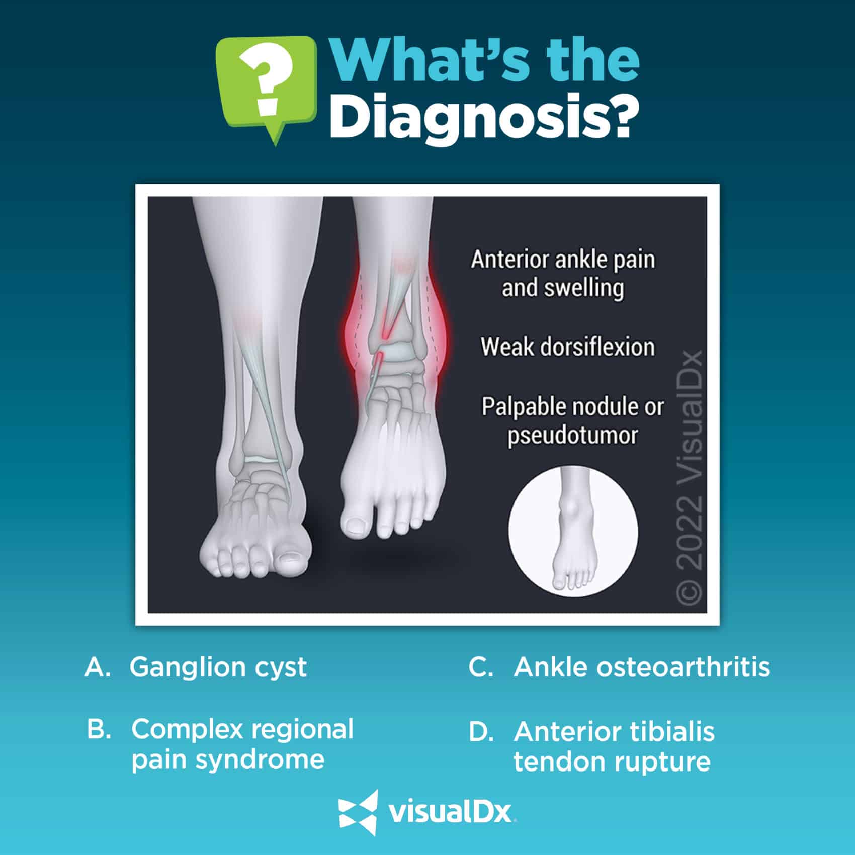 Anterior ankle pain and gait disturbance - Let’s diagnose