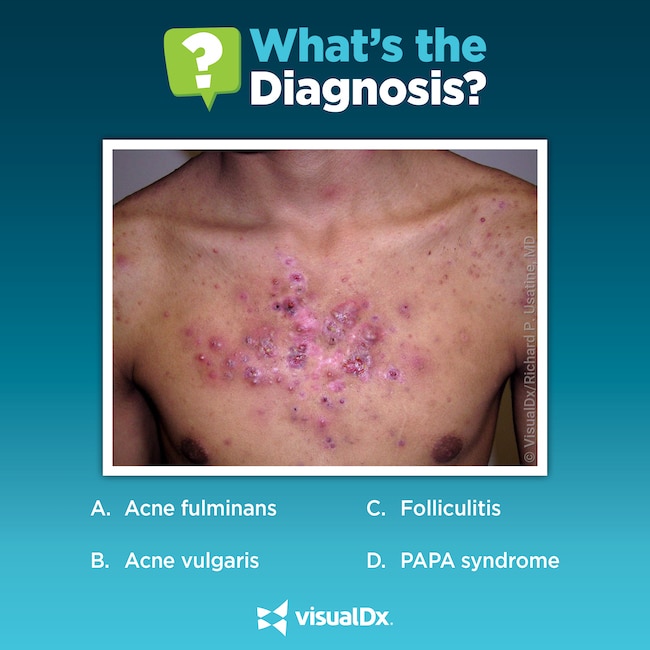 Young Bodybuilder With Painful Pustules On Chest - Let’s Diagnose