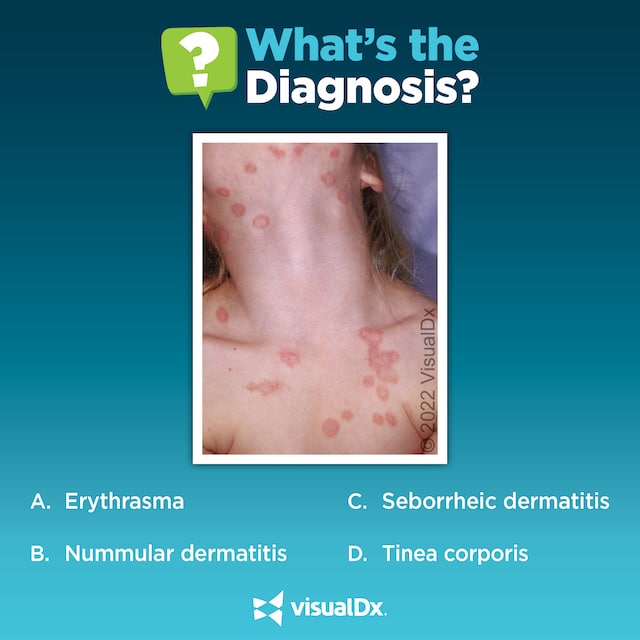 Is this girl’s new pet to blame for her rash? Let’s diagnose. | VisualDx