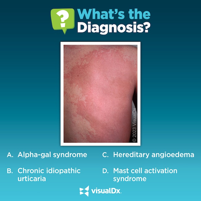 A 43-year-old man has hives, swelling of the face, and abdominal pain ...