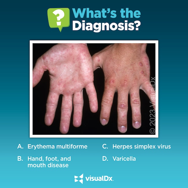 A 35-year-old man has a fever, sore throat, rash. Let’s diagnose ...