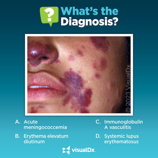 A 15-year-old girl has fever, abdominal pain, and a widespread rash ...