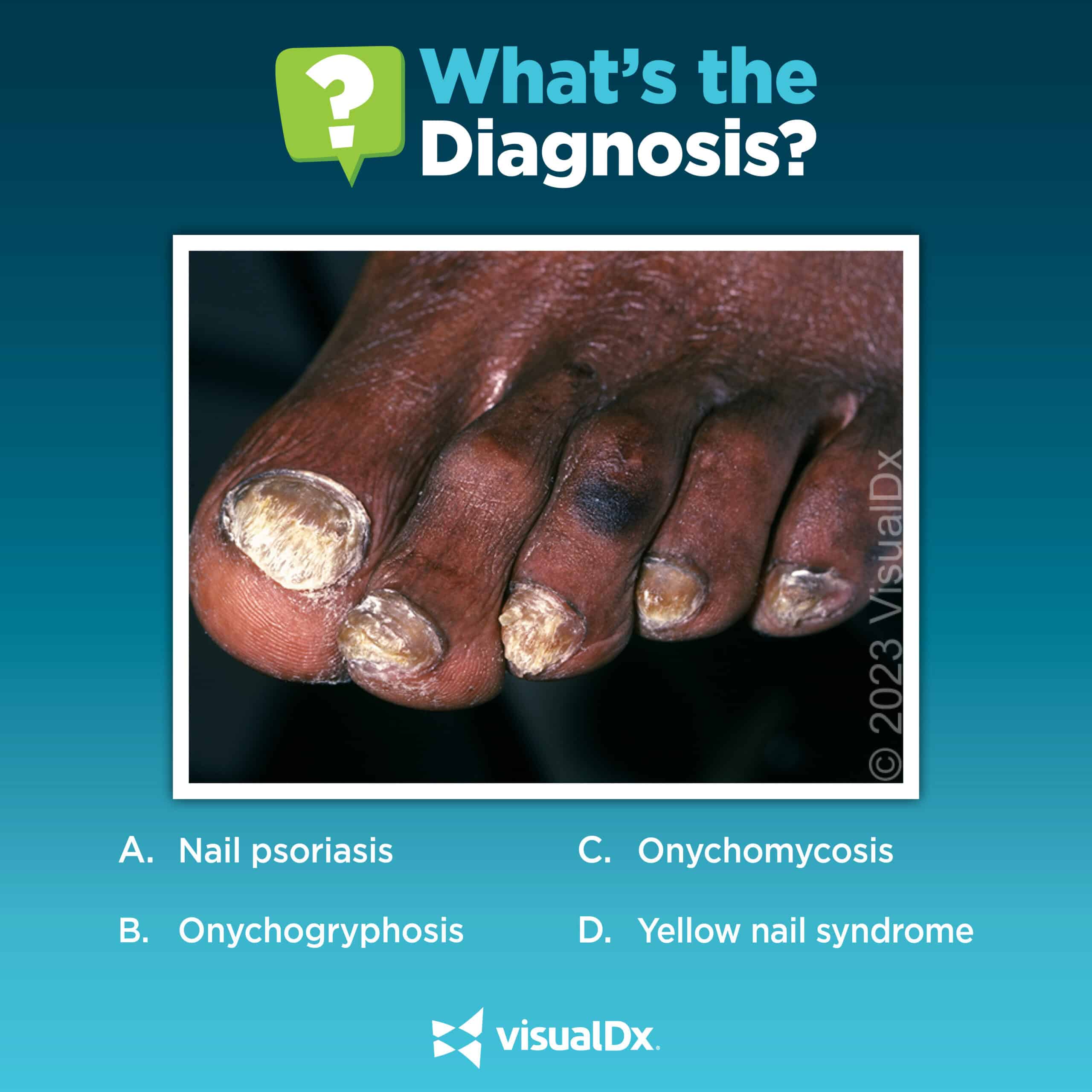 Quiz Time - What’s the condition on this woman’s toes? | VisualDx