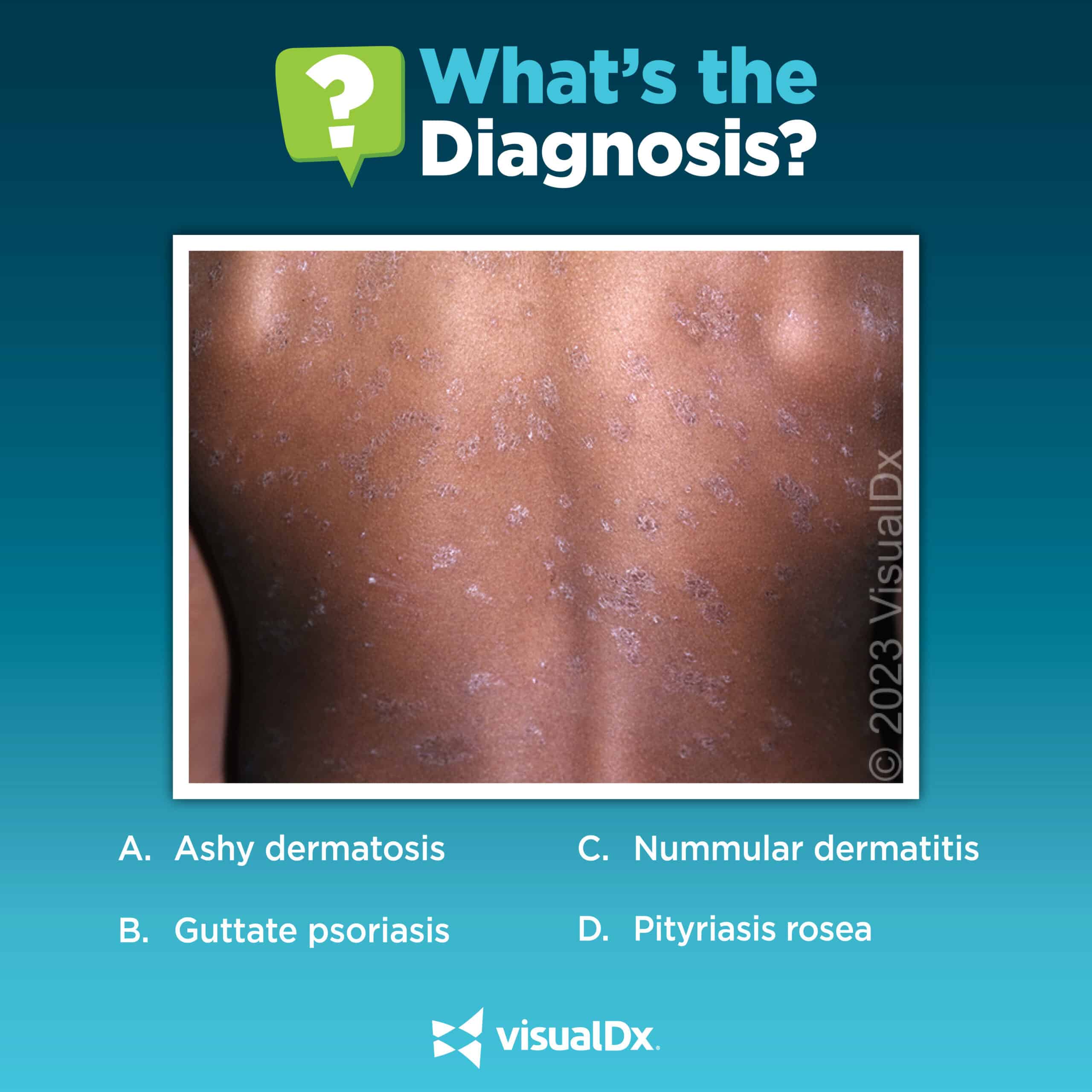 Whats Causing This Teens Itchy Rash On His Back Take The Quiz VisualDx